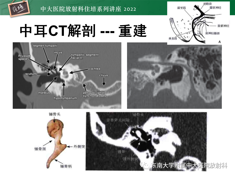 影像PPT - 【PPT】耳颞部发育异常影像评估-26