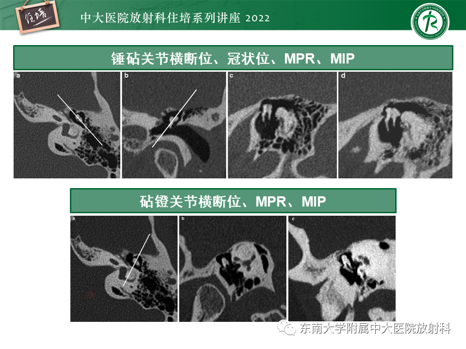 影像PPT - 【PPT】耳颞部发育异常影像评估-27