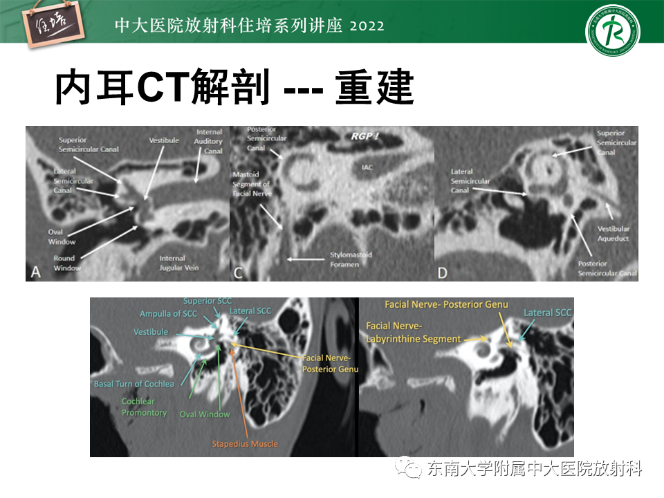 影像PPT - 【PPT】耳颞部发育异常影像评估-29