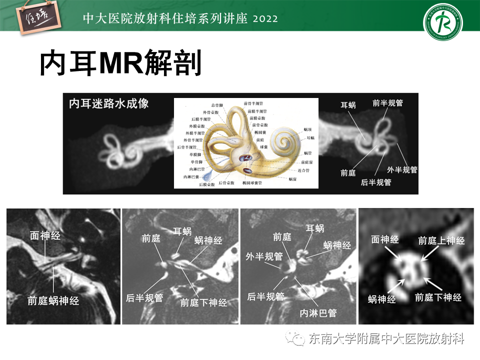 影像PPT - 【PPT】耳颞部发育异常影像评估-31