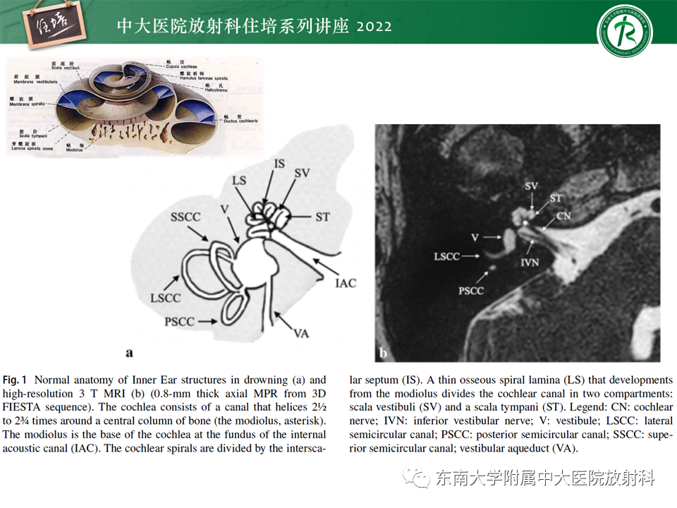 影像PPT - 【PPT】耳颞部发育异常影像评估-32