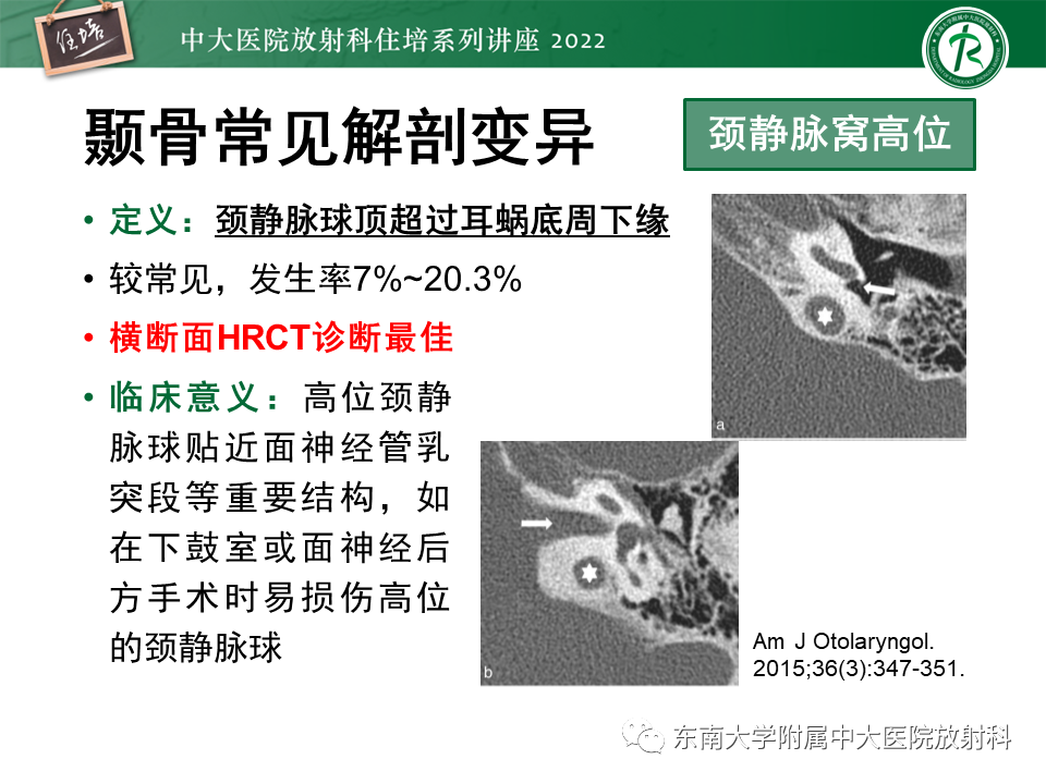 影像PPT - 【PPT】耳颞部发育异常影像评估-35