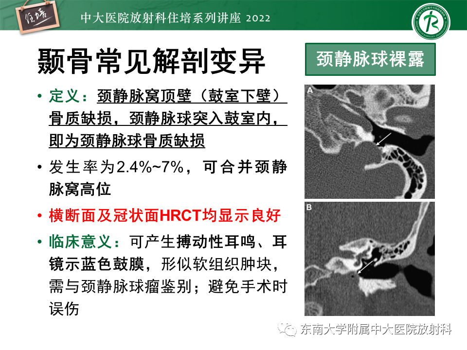影像PPT - 【PPT】耳颞部发育异常影像评估-36