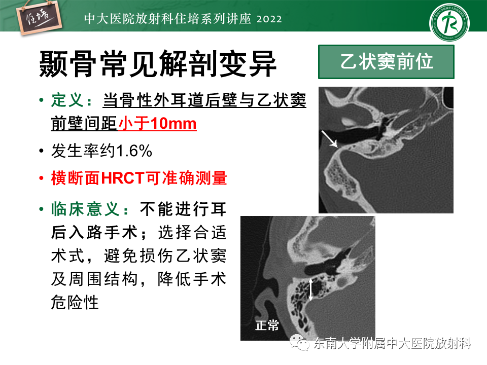 影像PPT - 【PPT】耳颞部发育异常影像评估-38