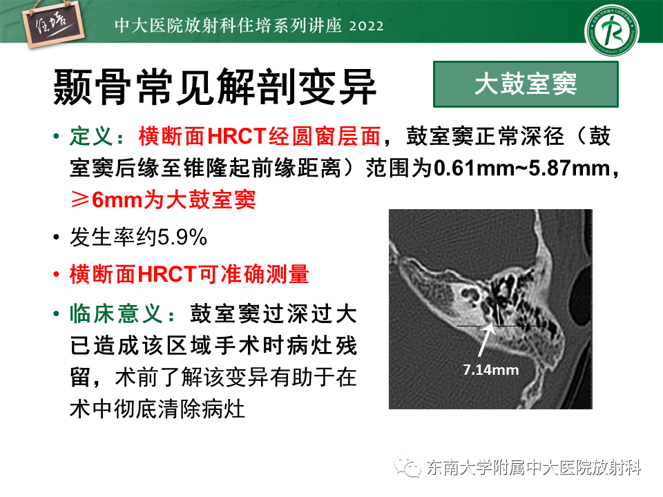 影像PPT - 【PPT】耳颞部发育异常影像评估-39