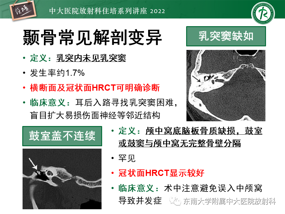 影像PPT - 【PPT】耳颞部发育异常影像评估-40
