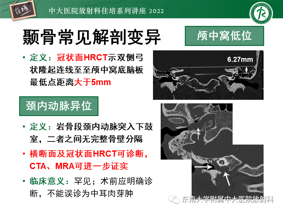 影像PPT - 【PPT】耳颞部发育异常影像评估-41
