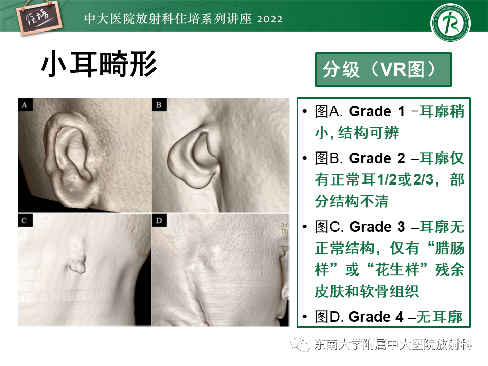 影像PPT - 【PPT】耳颞部发育异常影像评估-44