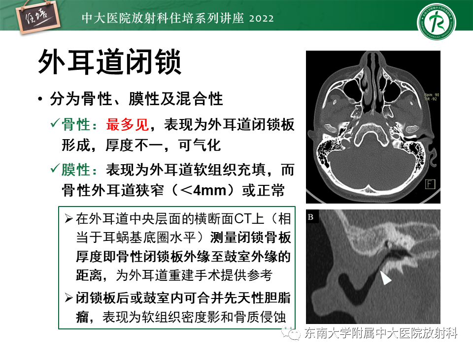 影像PPT - 【PPT】耳颞部发育异常影像评估-45