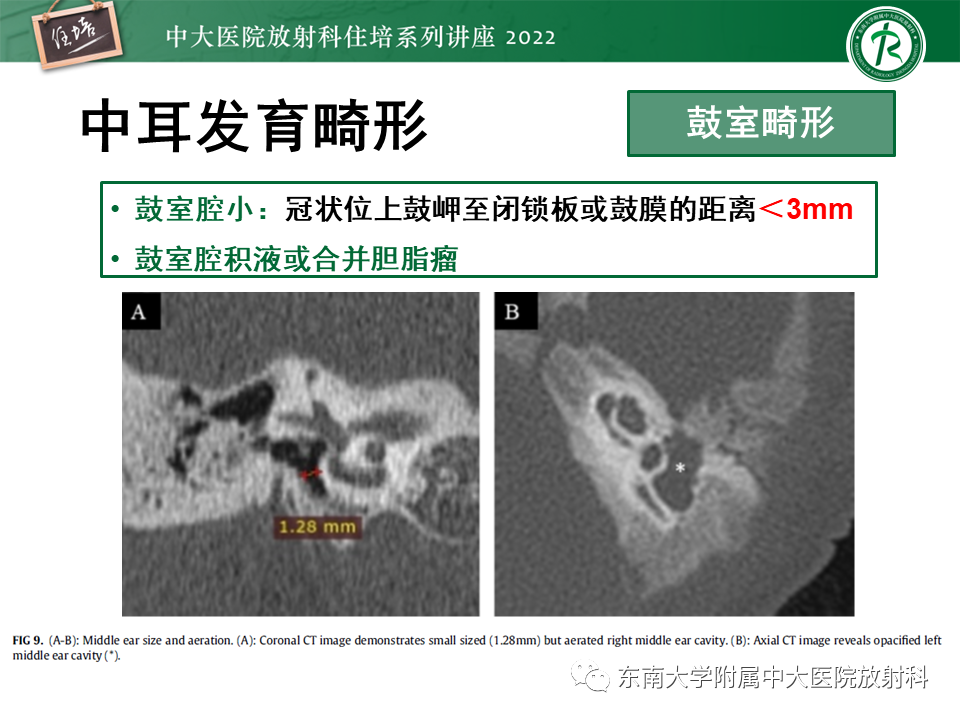 影像PPT - 【PPT】耳颞部发育异常影像评估-46