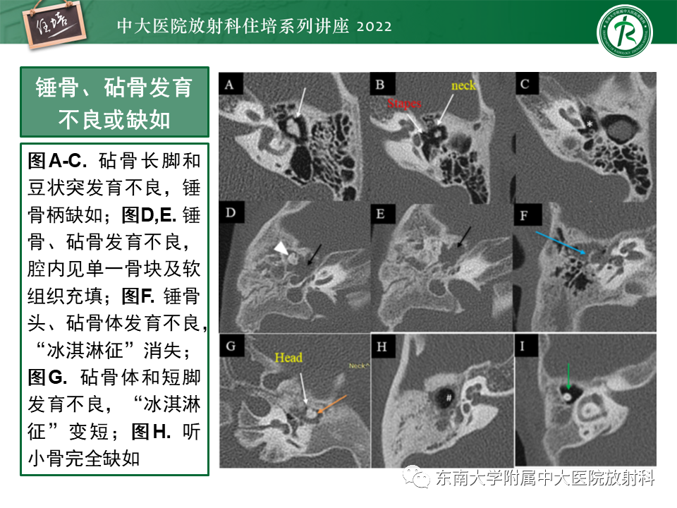 影像PPT - 【PPT】耳颞部发育异常影像评估-49