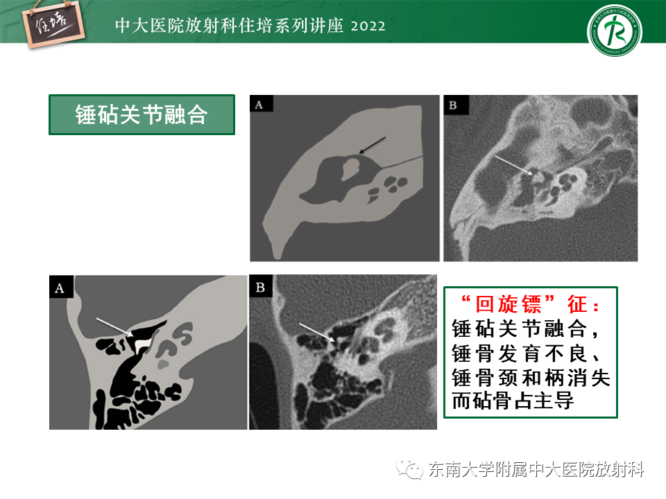 影像PPT - 【PPT】耳颞部发育异常影像评估-50