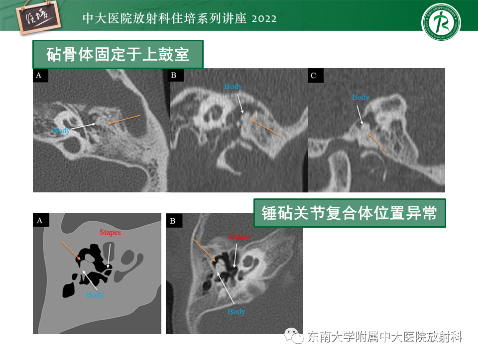 影像PPT - 【PPT】耳颞部发育异常影像评估-51