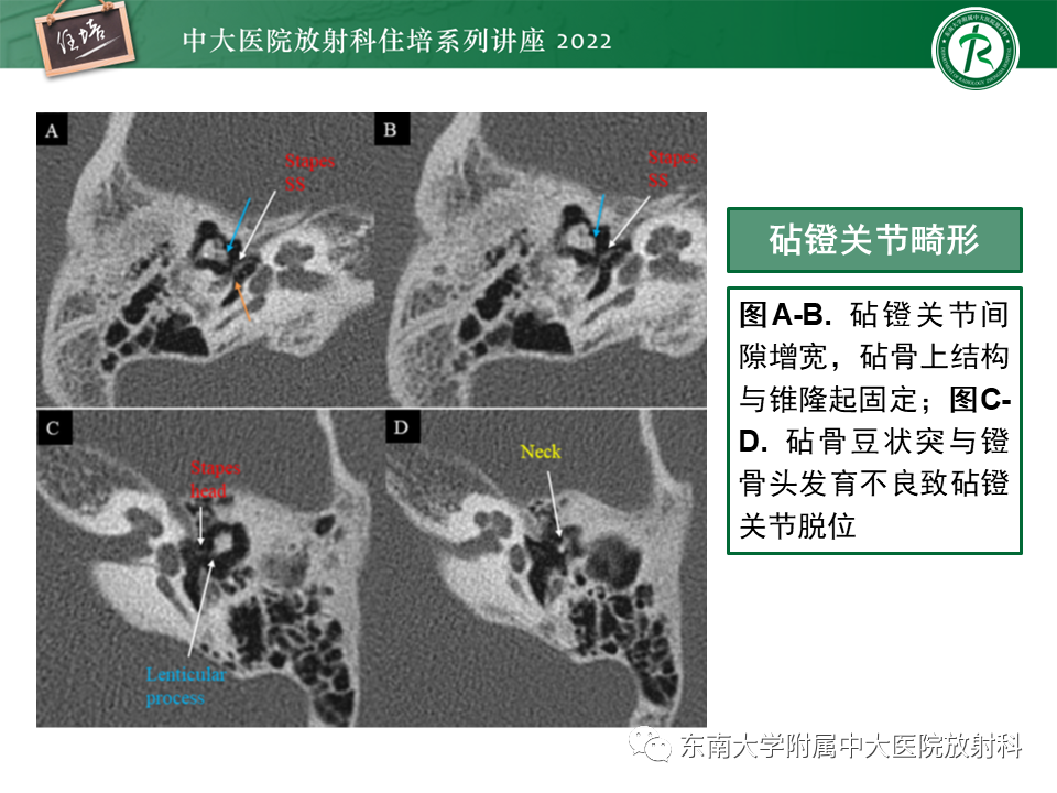 影像PPT - 【PPT】耳颞部发育异常影像评估-52