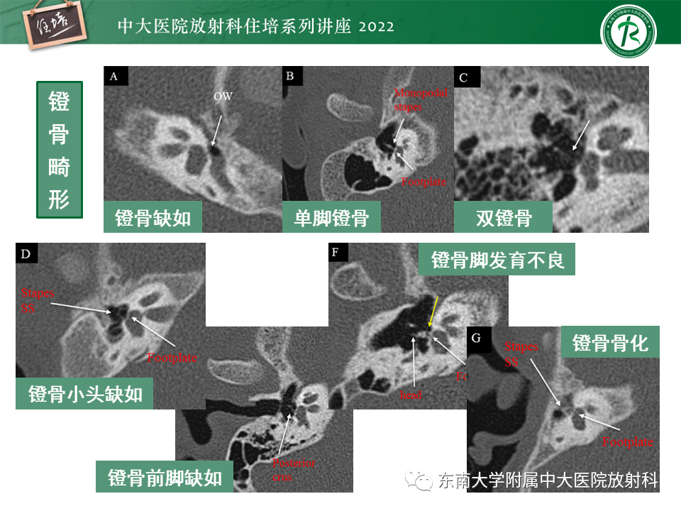 影像PPT - 【PPT】耳颞部发育异常影像评估-53