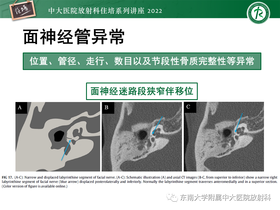 影像PPT - 【PPT】耳颞部发育异常影像评估-54