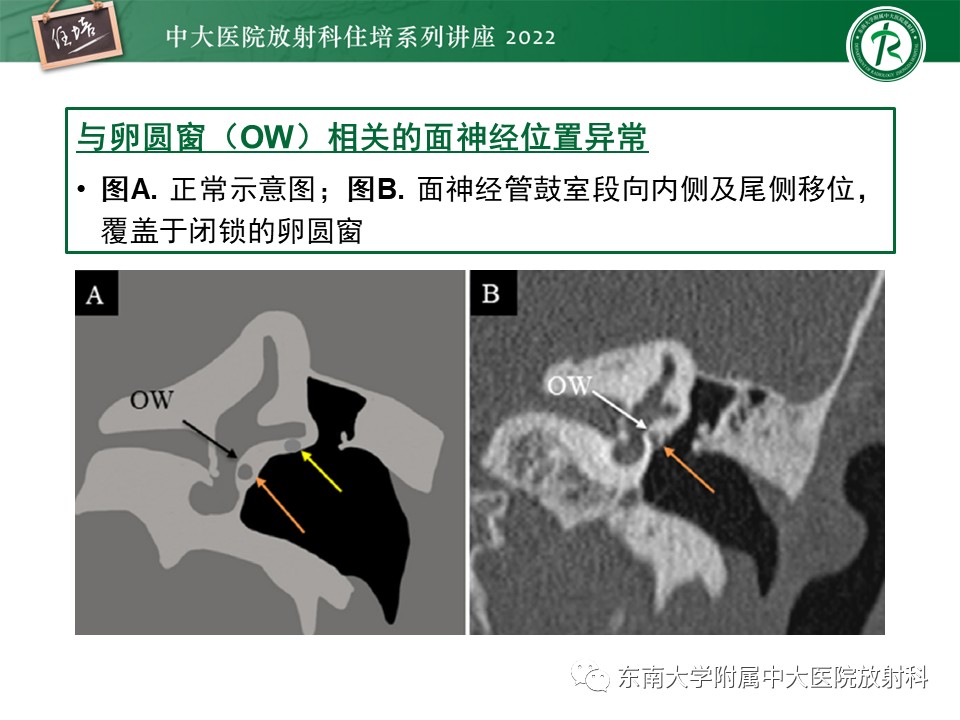 影像PPT - 【PPT】耳颞部发育异常影像评估-55