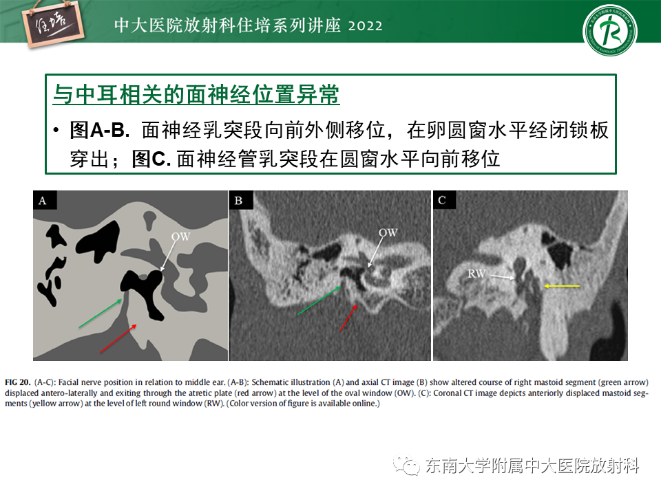 影像PPT - 【PPT】耳颞部发育异常影像评估-56