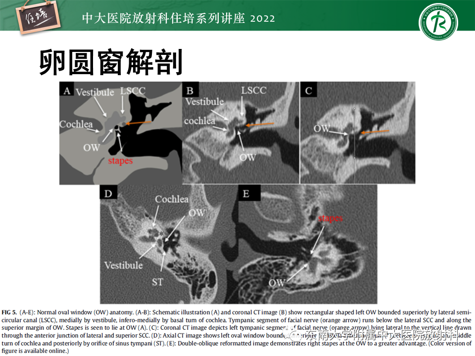 影像PPT - 【PPT】耳颞部发育异常影像评估-58