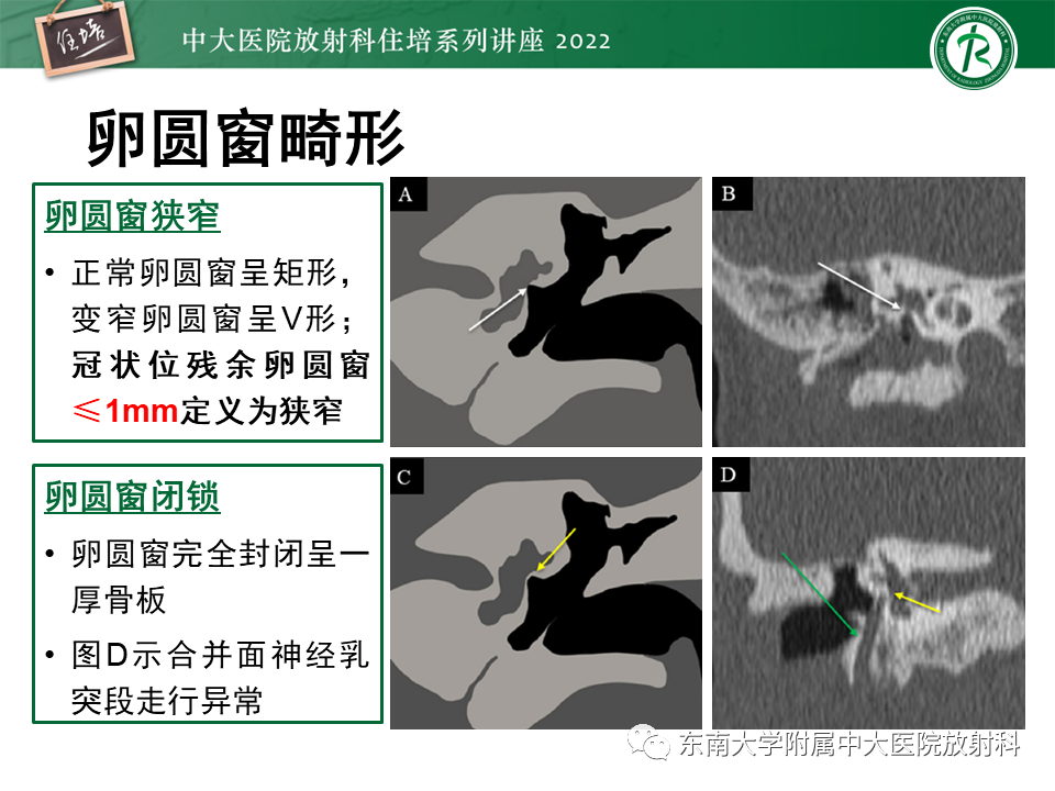 影像PPT - 【PPT】耳颞部发育异常影像评估-59