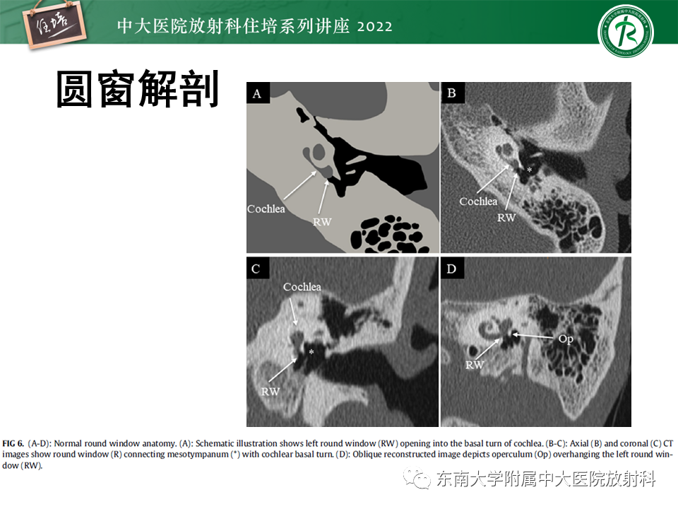 影像PPT - 【PPT】耳颞部发育异常影像评估-60