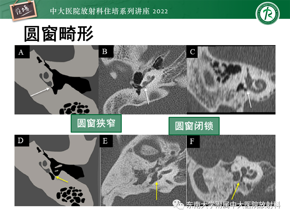 影像PPT - 【PPT】耳颞部发育异常影像评估-61