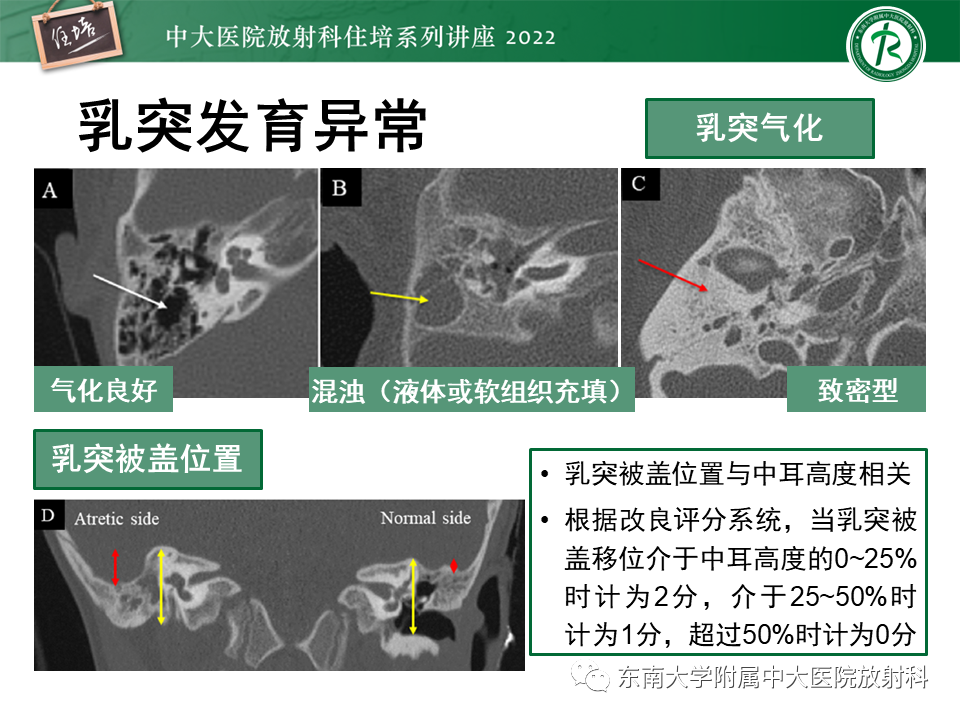 影像PPT - 【PPT】耳颞部发育异常影像评估-62