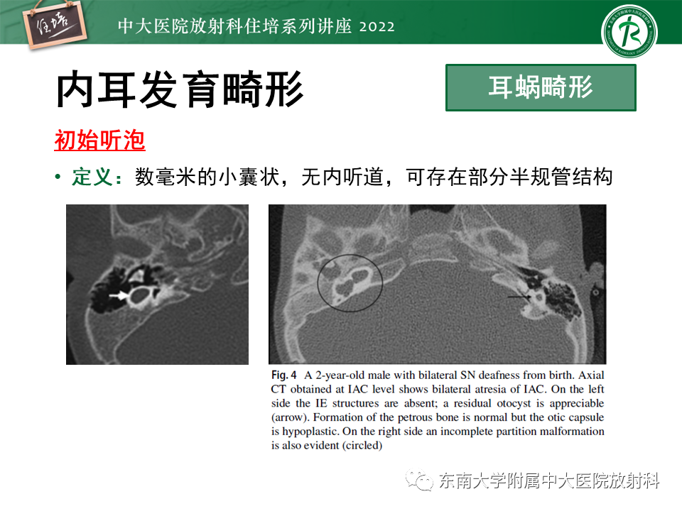 影像PPT - 【PPT】耳颞部发育异常影像评估-65