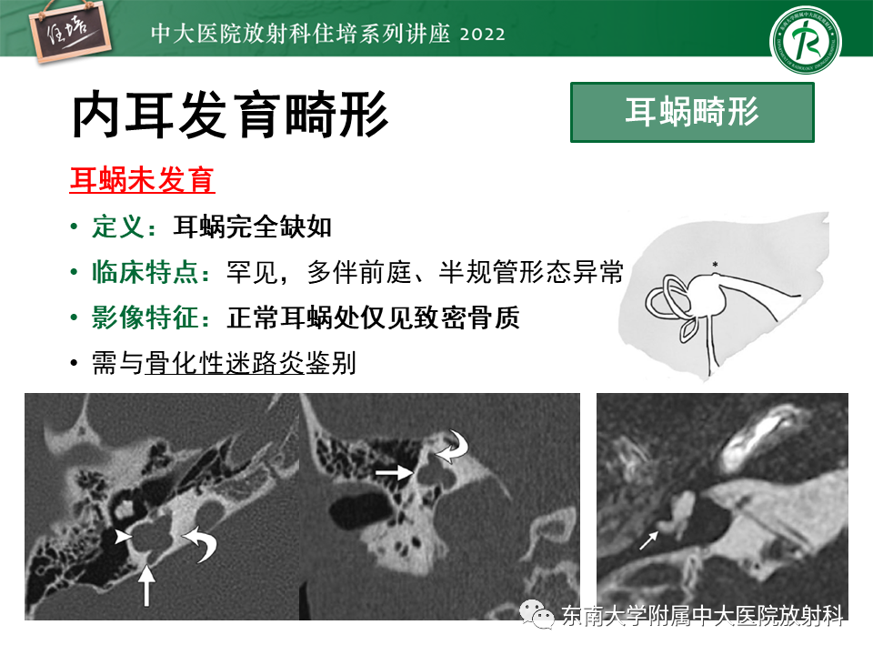 影像PPT - 【PPT】耳颞部发育异常影像评估-66