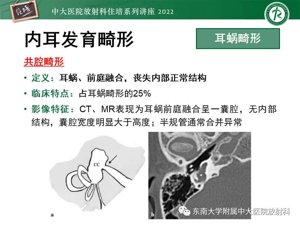 影像PPT - 【PPT】耳颞部发育异常影像评估-67