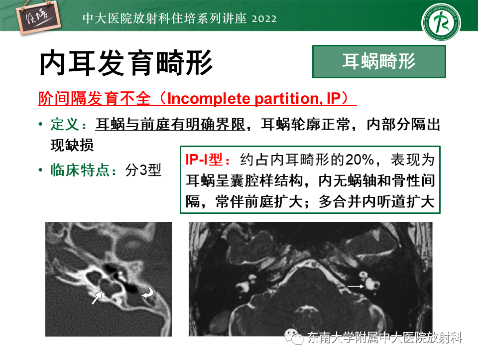影像PPT - 【PPT】耳颞部发育异常影像评估-69