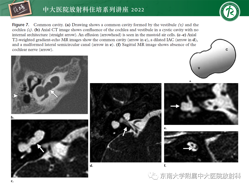 影像PPT - 【PPT】耳颞部发育异常影像评估-68