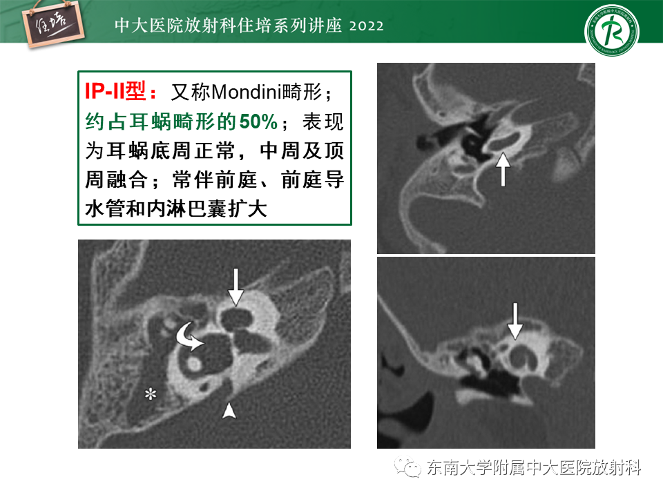 影像PPT - 【PPT】耳颞部发育异常影像评估-70
