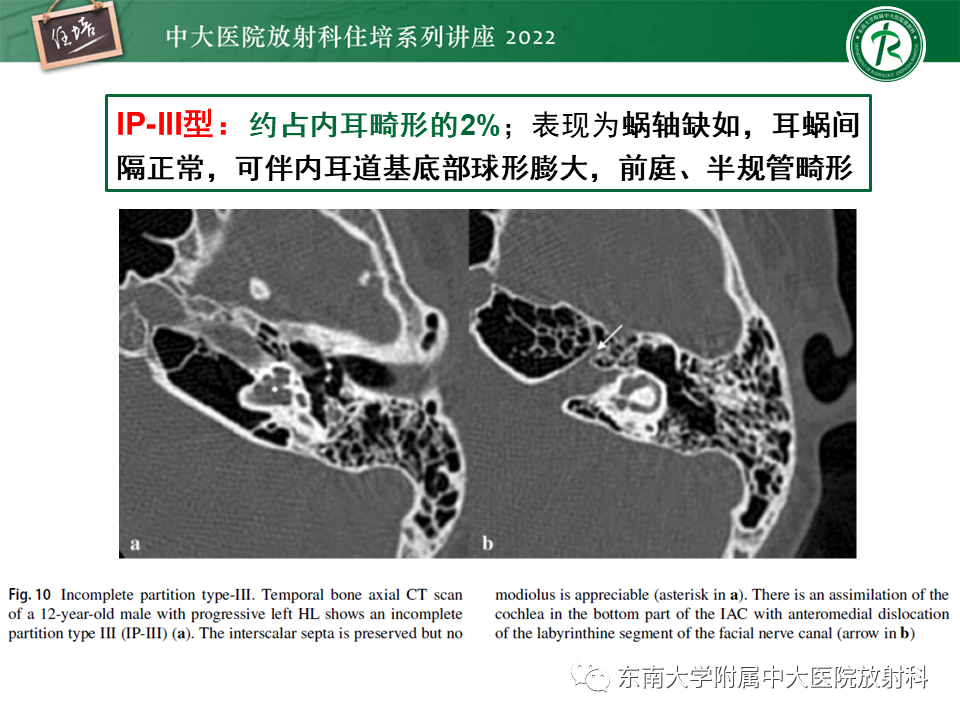 影像PPT - 【PPT】耳颞部发育异常影像评估-71