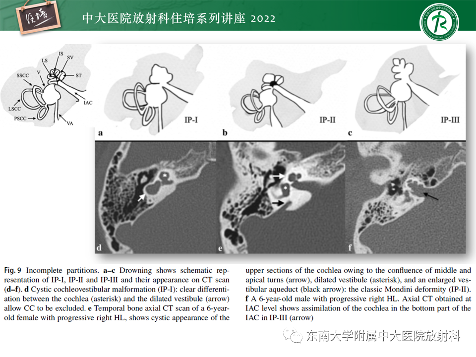 影像PPT - 【PPT】耳颞部发育异常影像评估-72