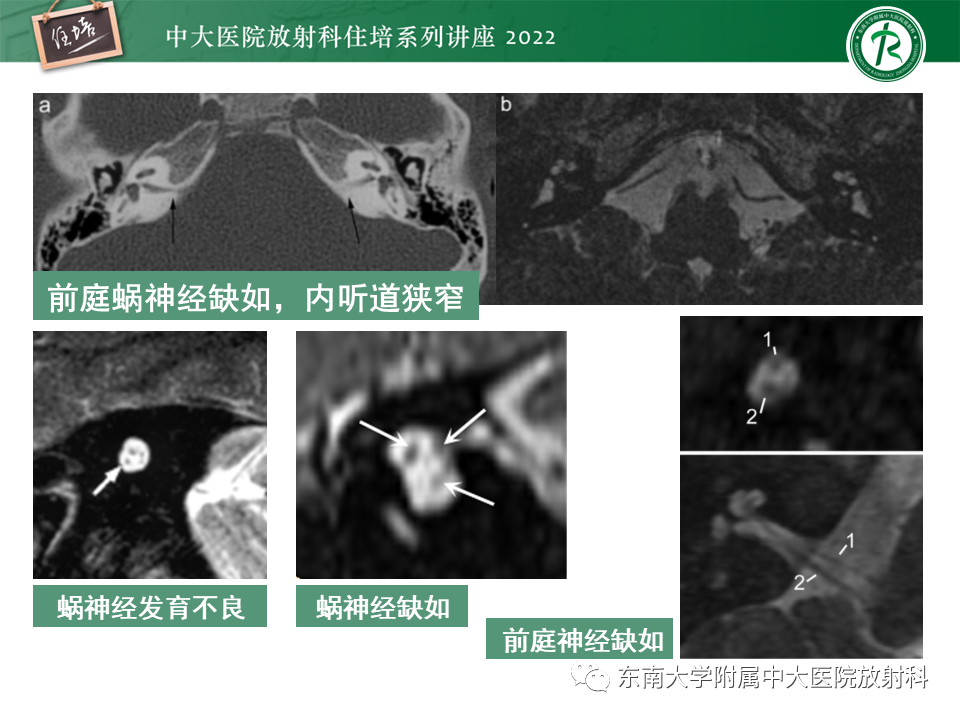 影像PPT - 【PPT】耳颞部发育异常影像评估-79