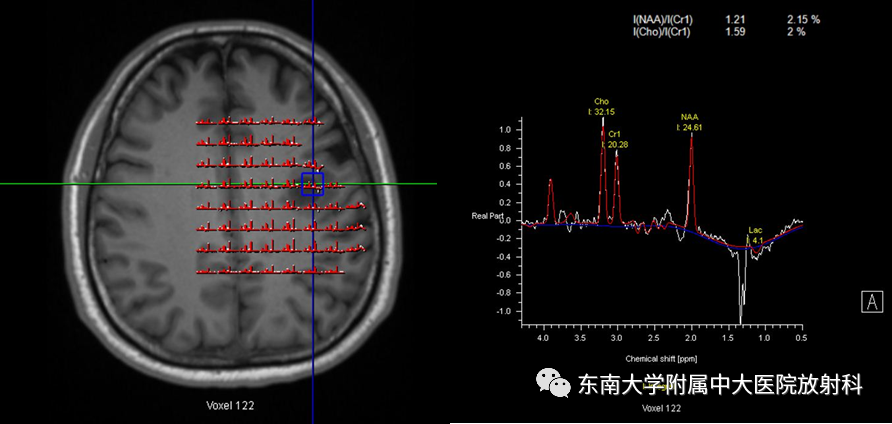 影像PPT - 【PPT】2022.07.08 神经系统疾病——脱髓鞘假瘤-3 影像PPT - 【PPT】2022.07.08 神经系统疾病——脱髓鞘假瘤-3