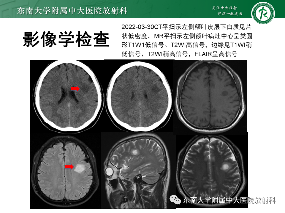 影像PPT - 【PPT】2022.07.08 神经系统疾病——脱髓鞘假瘤-8 影像PPT - 【PPT】2022.07.08 神经系统疾病——脱髓鞘假瘤-8