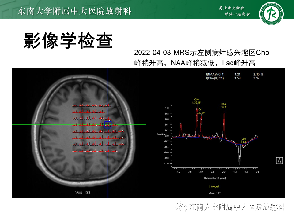 影像PPT - 【PPT】2022.07.08 神经系统疾病——脱髓鞘假瘤-10 影像PPT - 【PPT】2022.07.08 神经系统疾病——脱髓鞘假瘤-10