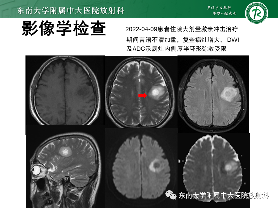 影像PPT - 【PPT】2022.07.08 神经系统疾病——脱髓鞘假瘤-11 影像PPT - 【PPT】2022.07.08 神经系统疾病——脱髓鞘假瘤-11