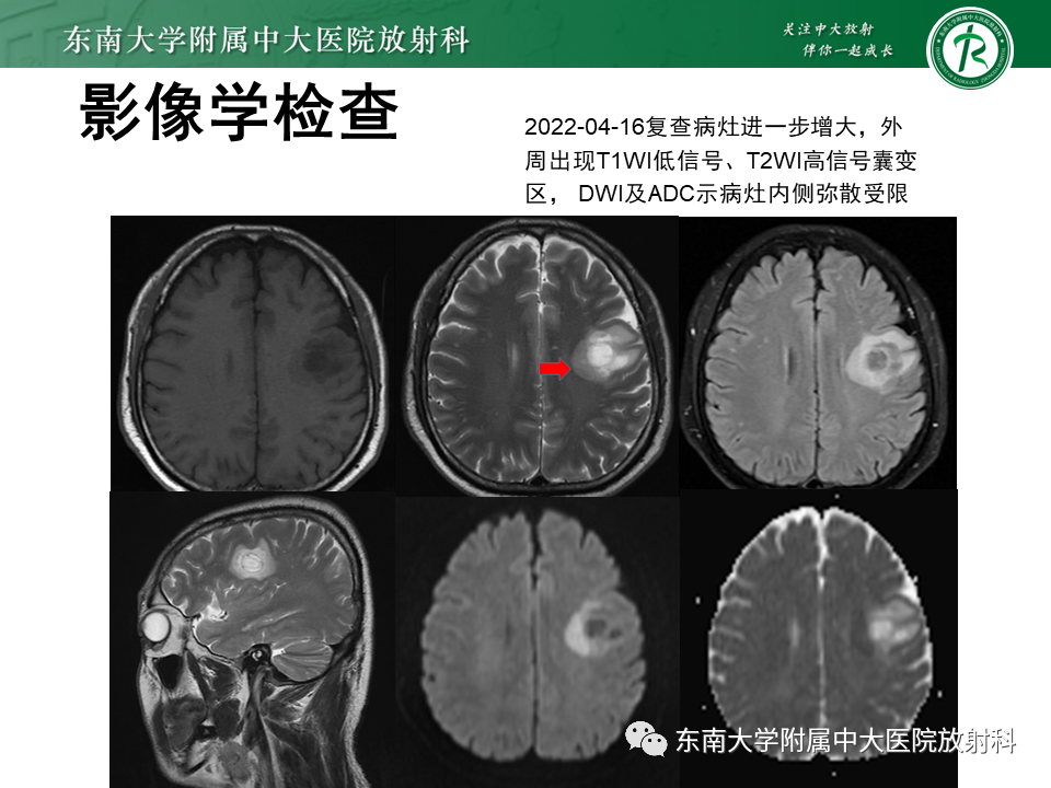 影像PPT - 【PPT】2022.07.08 神经系统疾病——脱髓鞘假瘤-12 影像PPT - 【PPT】2022.07.08 神经系统疾病——脱髓鞘假瘤-12