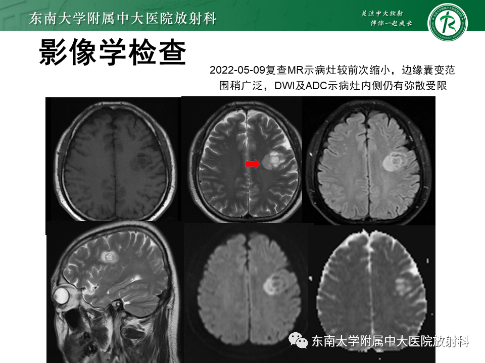 影像PPT - 【PPT】2022.07.08 神经系统疾病——脱髓鞘假瘤-13 影像PPT - 【PPT】2022.07.08 神经系统疾病——脱髓鞘假瘤-13