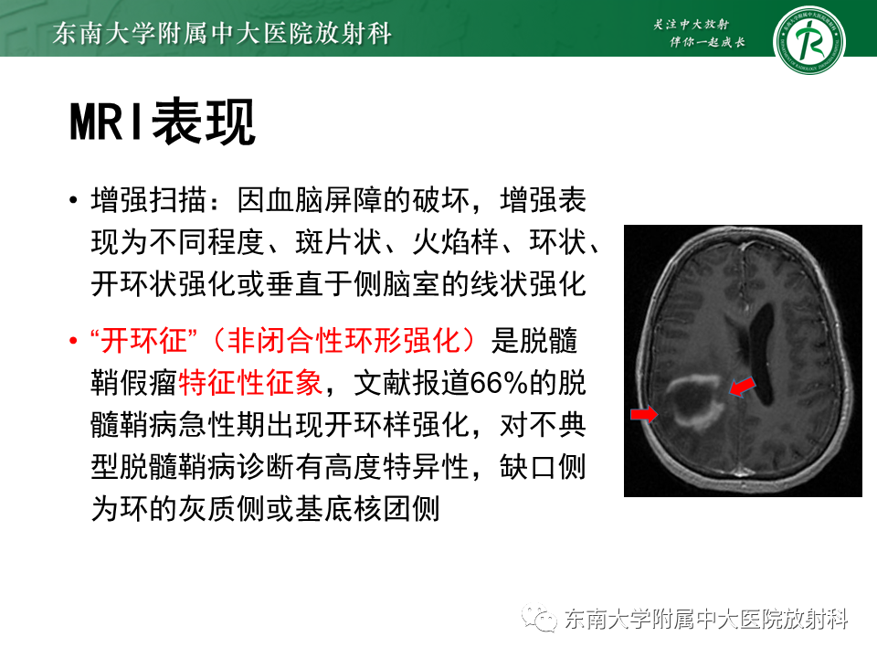 影像PPT - 【PPT】2022.07.08 神经系统疾病——脱髓鞘假瘤-30 影像PPT - 【PPT】2022.07.08 神经系统疾病——脱髓鞘假瘤-30