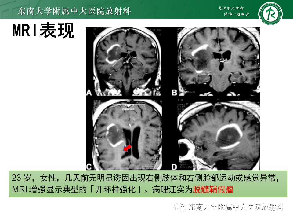 影像PPT - 【PPT】2022.07.08 神经系统疾病——脱髓鞘假瘤-31 影像PPT - 【PPT】2022.07.08 神经系统疾病——脱髓鞘假瘤-31