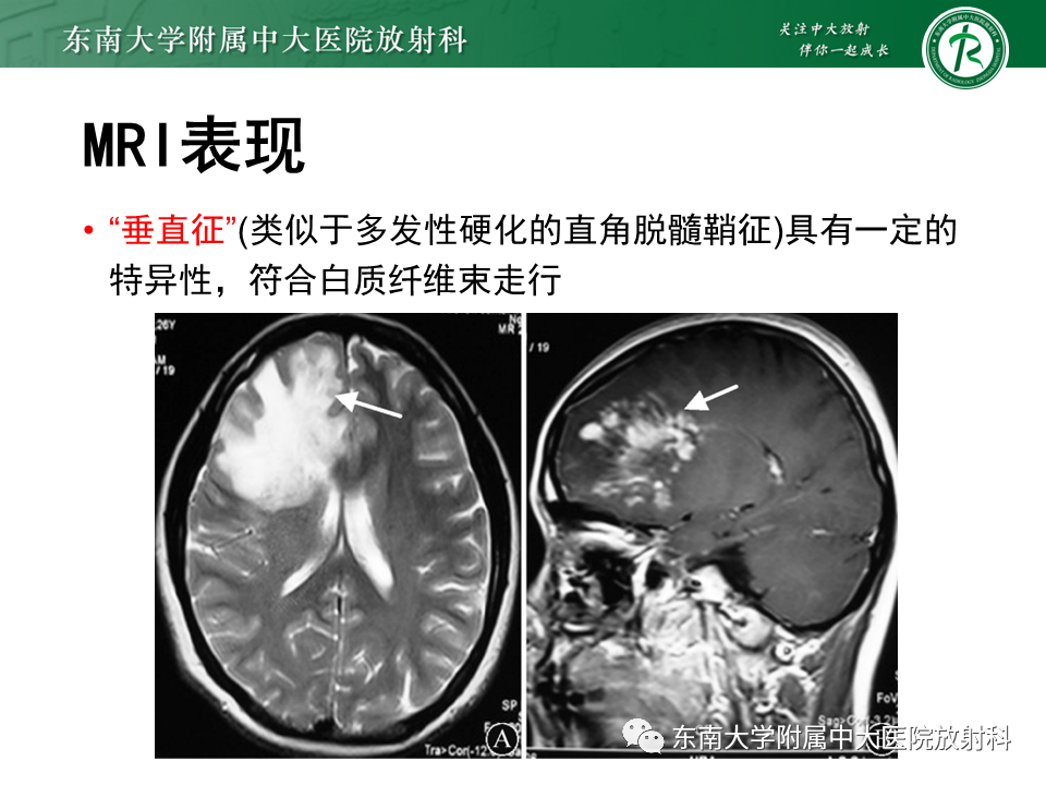 影像PPT - 【PPT】2022.07.08 神经系统疾病——脱髓鞘假瘤-32 影像PPT - 【PPT】2022.07.08 神经系统疾病——脱髓鞘假瘤-32