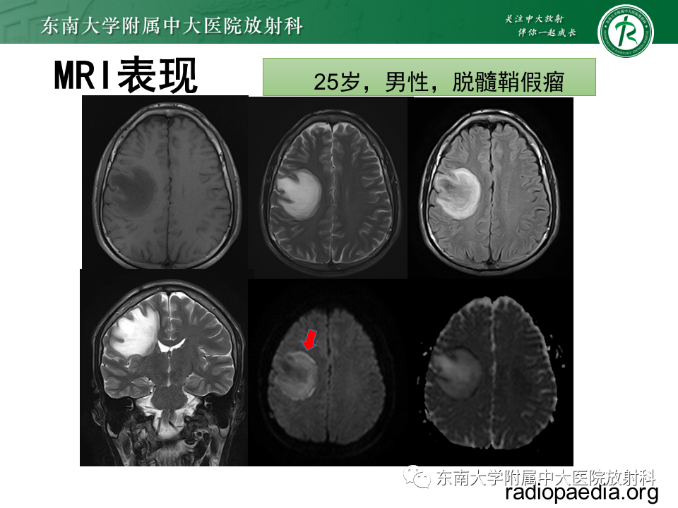 影像PPT - 【PPT】2022.07.08 神经系统疾病——脱髓鞘假瘤-33 影像PPT - 【PPT】2022.07.08 神经系统疾病——脱髓鞘假瘤-33