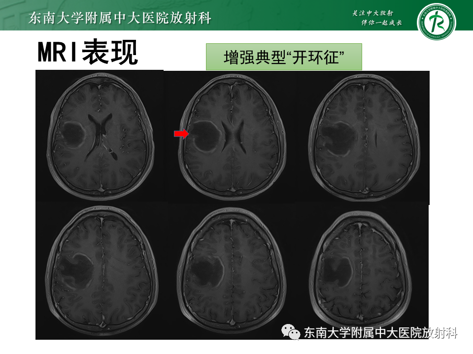 影像PPT - 【PPT】2022.07.08 神经系统疾病——脱髓鞘假瘤-34 影像PPT - 【PPT】2022.07.08 神经系统疾病——脱髓鞘假瘤-34