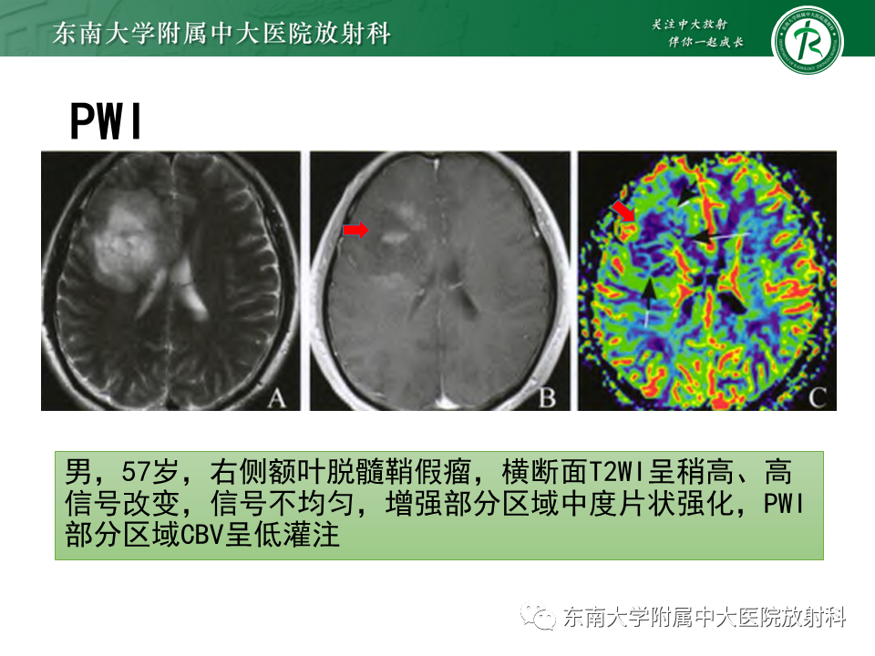 影像PPT - 【PPT】2022.07.08 神经系统疾病——脱髓鞘假瘤-36 影像PPT - 【PPT】2022.07.08 神经系统疾病——脱髓鞘假瘤-36