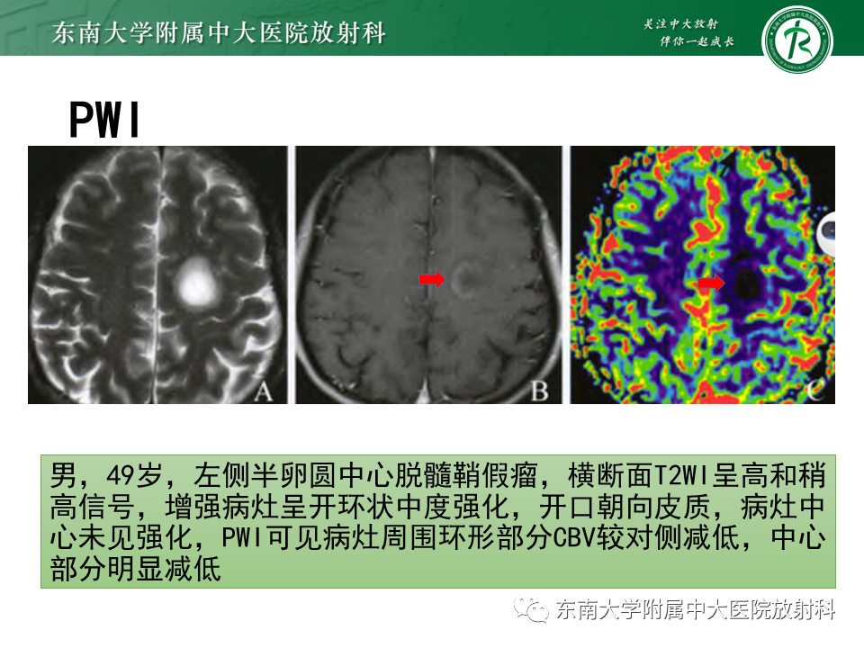 影像PPT - 【PPT】2022.07.08 神经系统疾病——脱髓鞘假瘤-37 影像PPT - 【PPT】2022.07.08 神经系统疾病——脱髓鞘假瘤-37