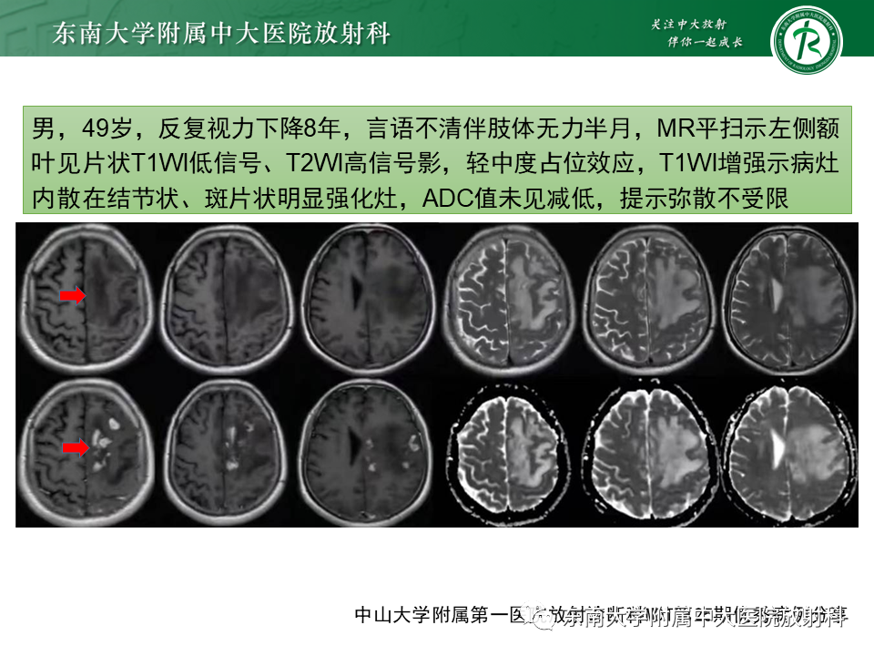 影像PPT - 【PPT】2022.07.08 神经系统疾病——脱髓鞘假瘤-39 影像PPT - 【PPT】2022.07.08 神经系统疾病——脱髓鞘假瘤-39